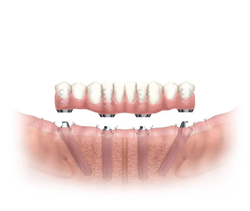 all-on-4-dental-implants-center