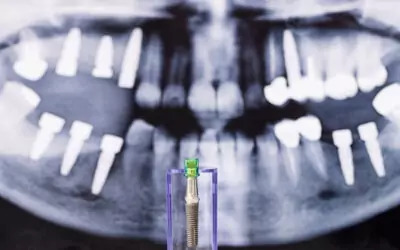 Which dental implants last the longest
