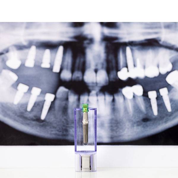 dental-implant-and-x-ray-picture