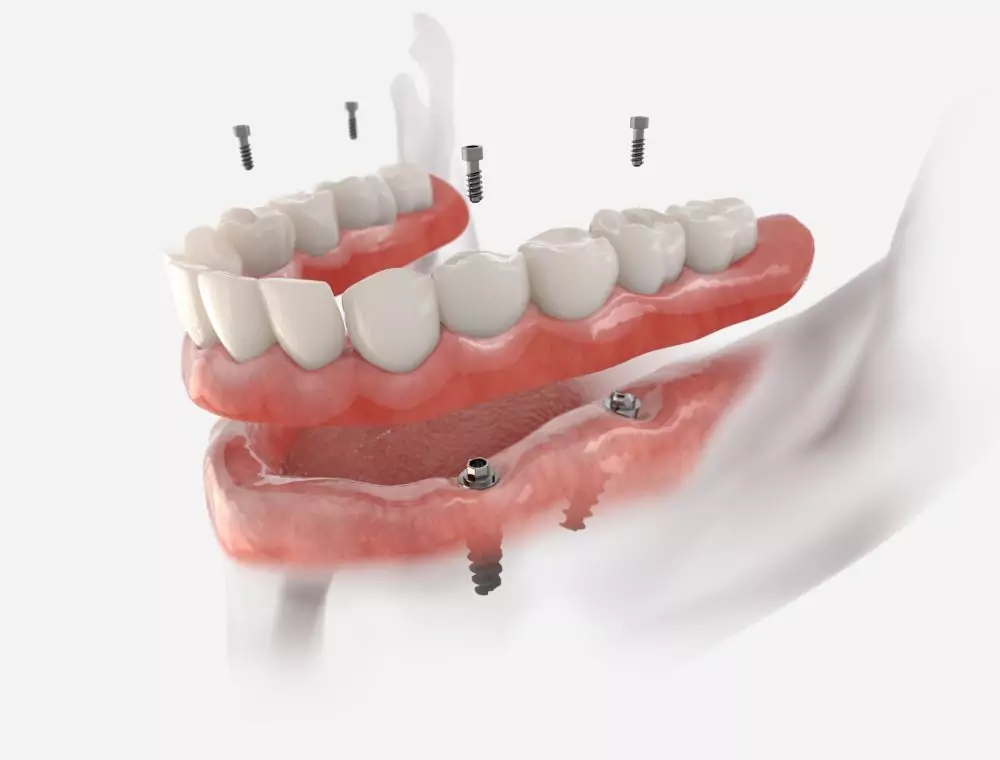Cosmetic-Dentistry-Perfect-Smile-Dental-Services-in-Lauderhill-Florida