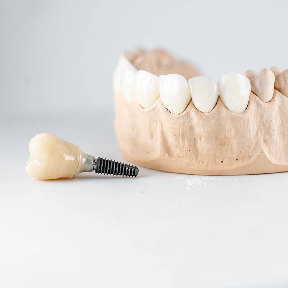 Model of artificial jaw and dental implant