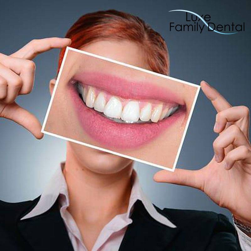 dental-bonding-at-Luxe-Dental-dentist-in-lauderhill-fl