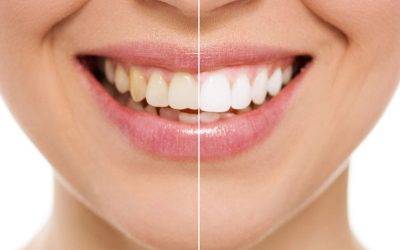 Teeth Whitening Side Effects Truth: What You Need to Know