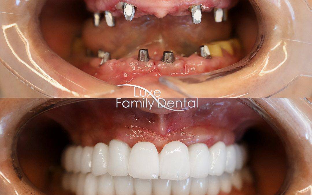 before and after dental implants all on 4