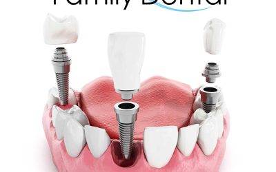 Unveiling the Value Behind Your Dental Implants