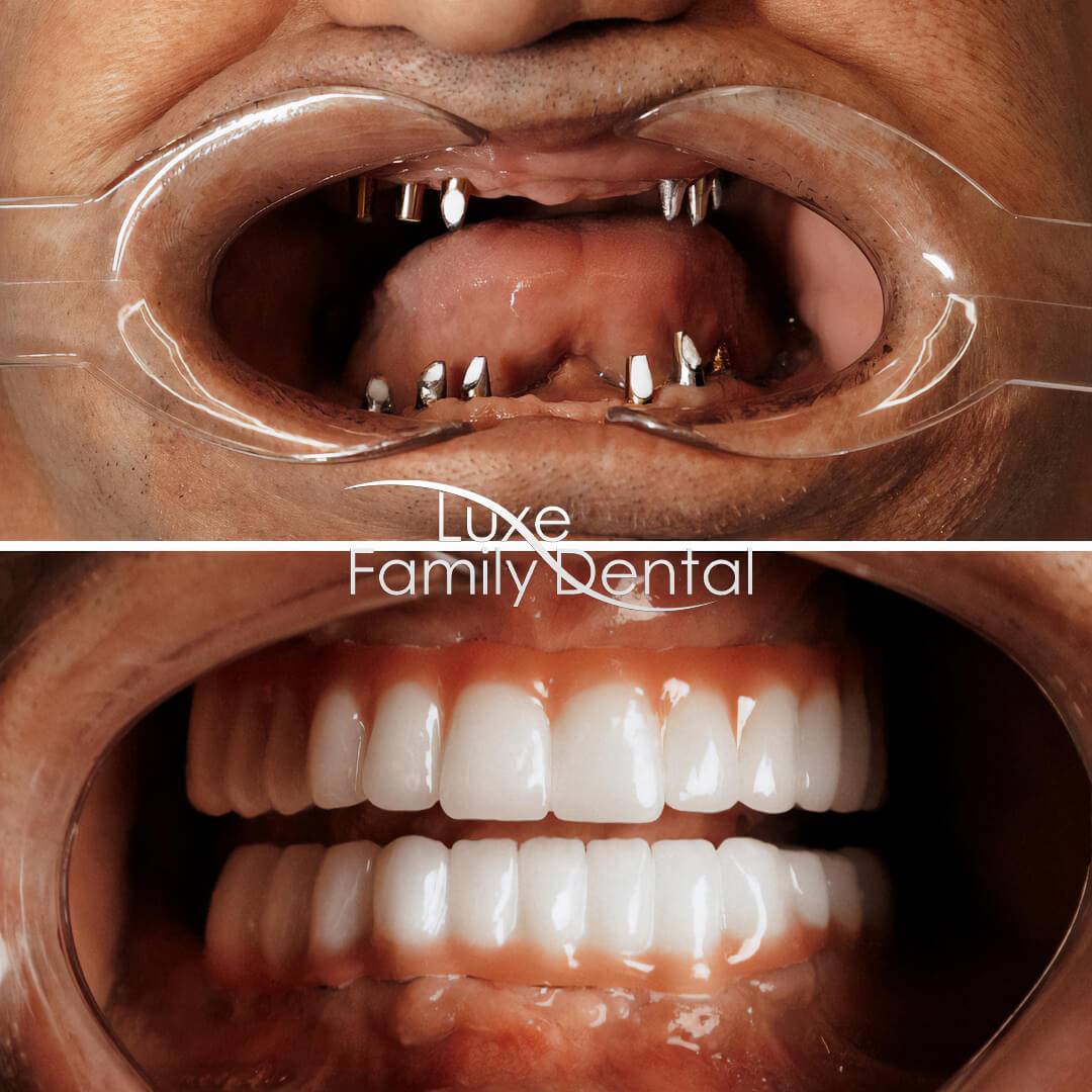 All on 4 Dental Implants - Full Mouth Reconstruction at Luxe Den