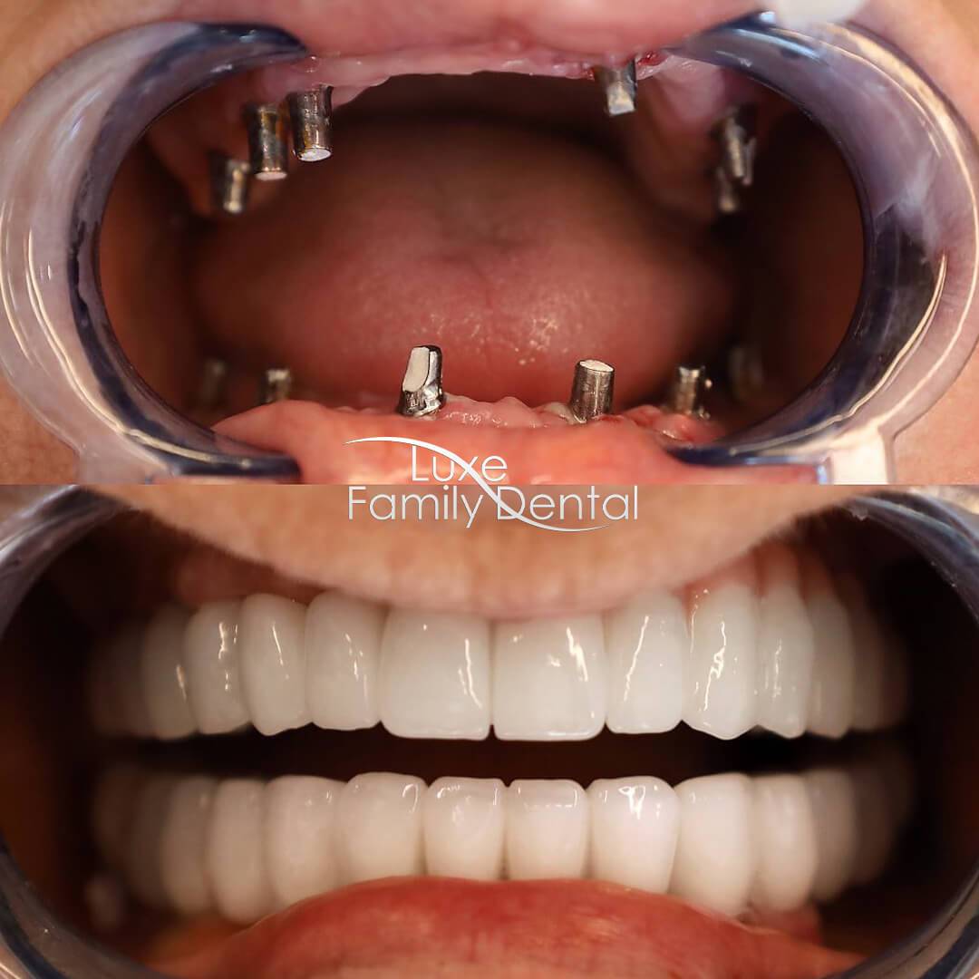 All on 4 Smile Design - Full mouth Dental Implants 01