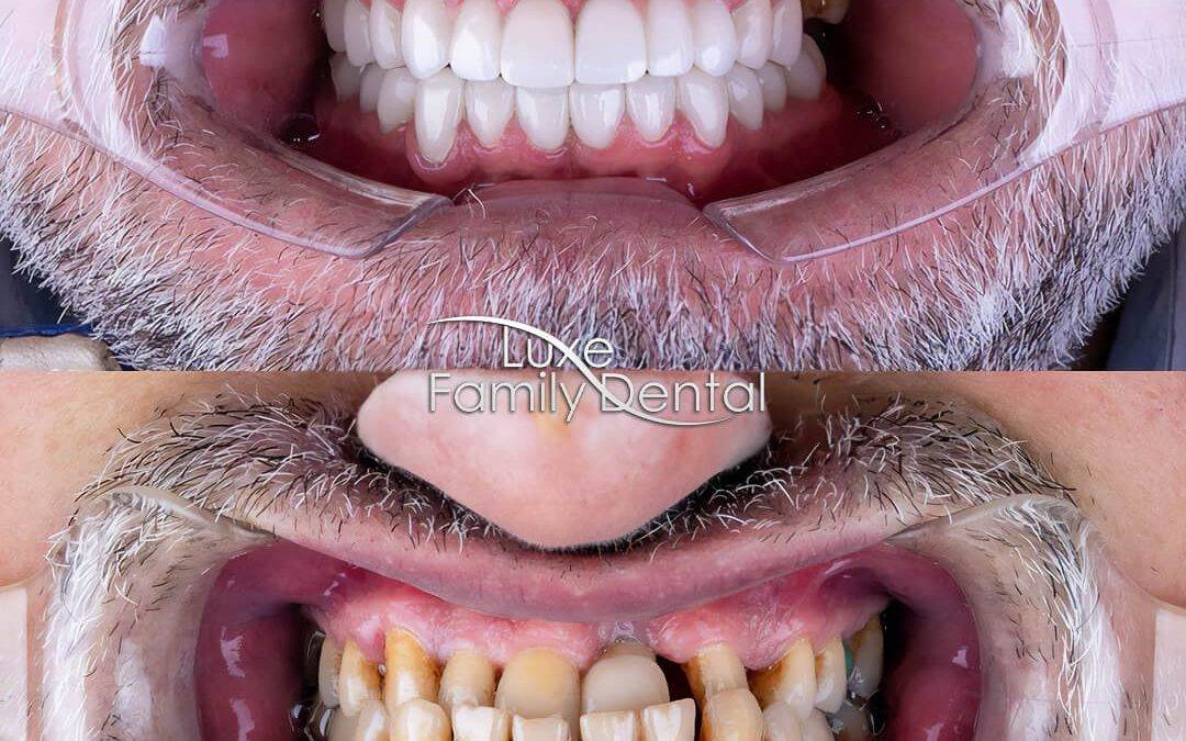 Full mouth All on 4 Dental Implants at Luxe Family Dental in Lau