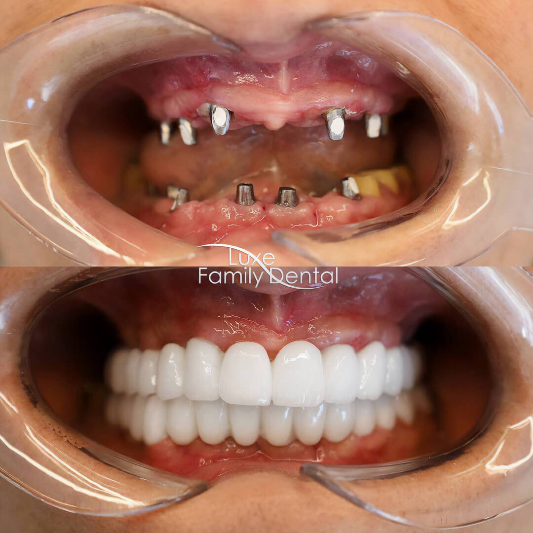 before and after dental implants all on 4