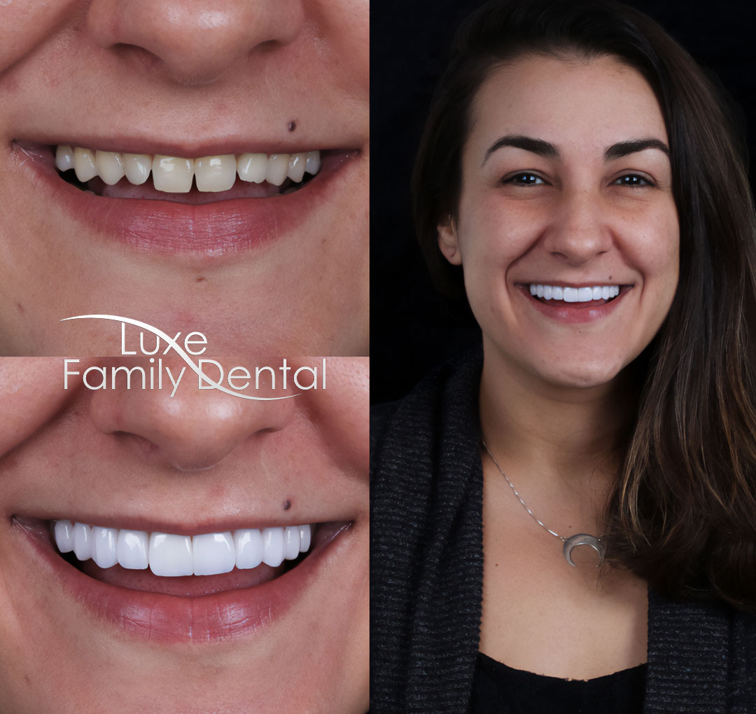 porcelain veneers