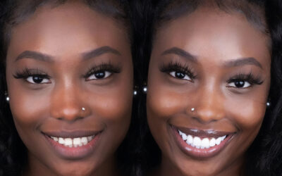 Do Teeth Whitening Products Steal Your Enamel’s Shine?