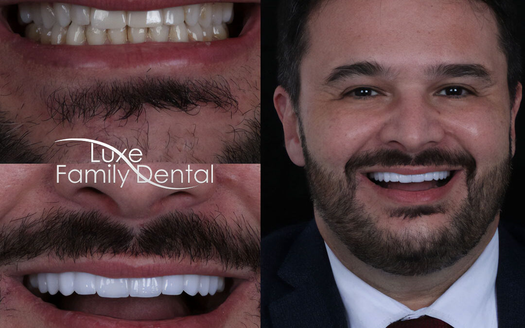 Upper-teeth-Porcelain-Veneers-Smile-Design-at-Luxe-Dental-in-Lauderhill-FL