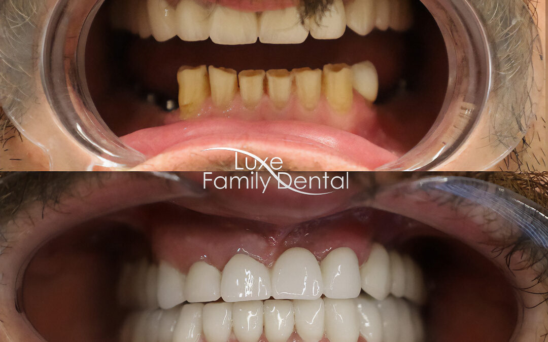 Bottom reconstruction with Dental Implants and Teeth Whitening on Top 01