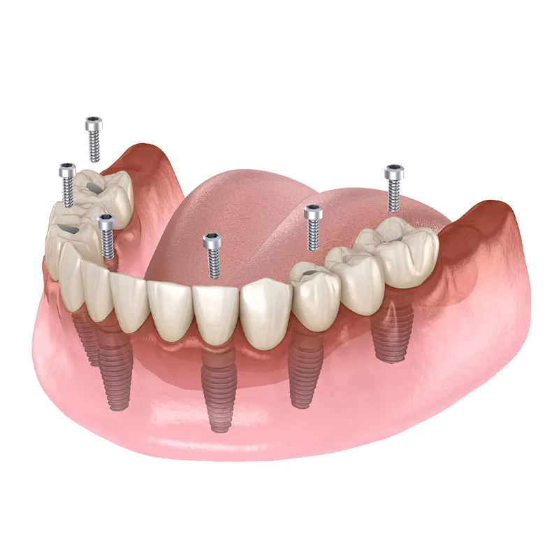 Do-All-on-Four-implants-look-fake