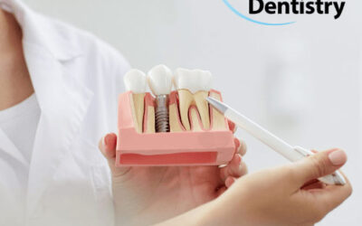 Why Dental Implants Are Worth the Investment