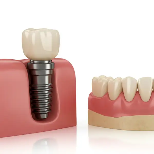 Dental Implant at Luxe Dental FL copy.webp