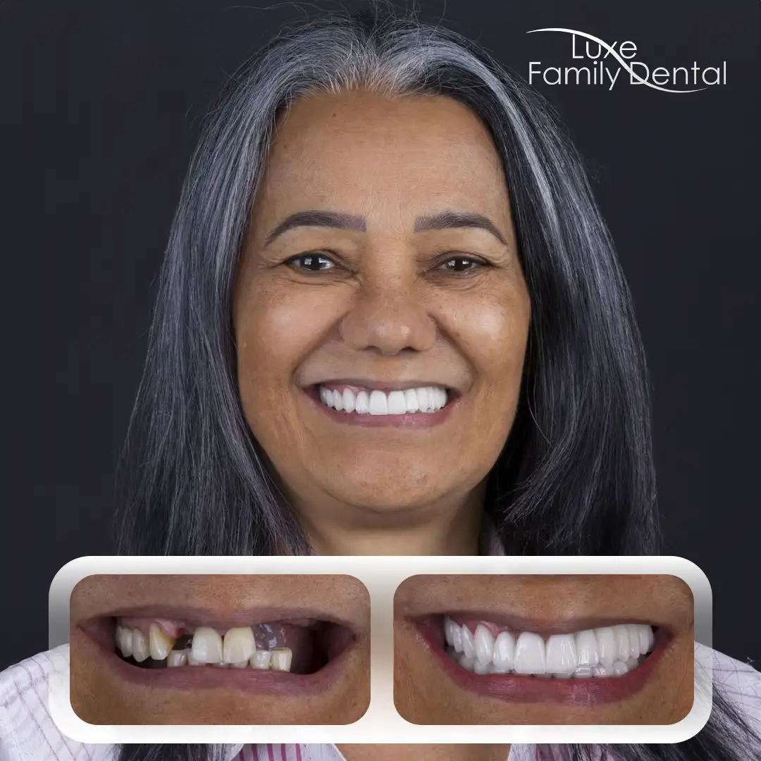 Dentures case 141 at Luxe Dental FL