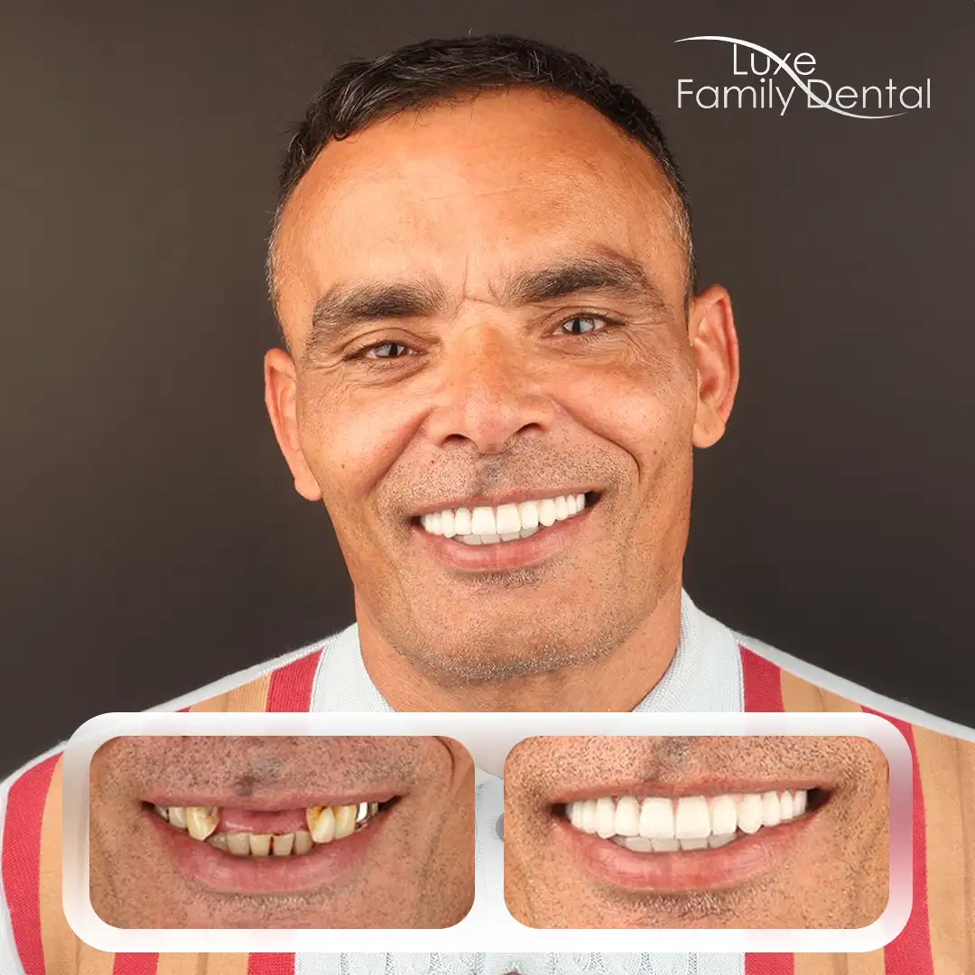 Dentures case at Luxe Dental FL