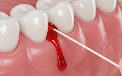 Why Do Gums Bleed When Flossing